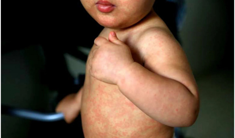 Ministerio de Salud insta a inmunizar a niños contra el sarampión